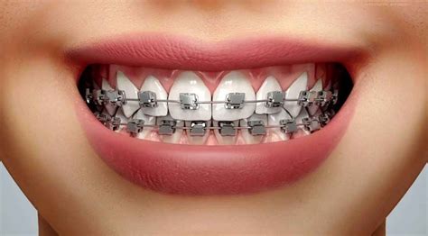 what is self ligating braces